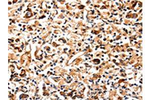 The image on the left is immunohistochemistry of paraffin-embedded Human gastric cancer tissue using ABIN7129022(COX8A Antibody) at dilution 1/12, on the right is treated with fusion protein. (COX8A antibody)