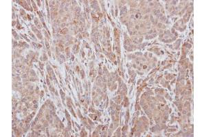 IHC-P Image Immunohistochemical analysis of paraffin-embedded A549 xenograft, using ADAMTS5, antibody at 1:100 dilution. (ADAMTS5 antibody  (C-Term))