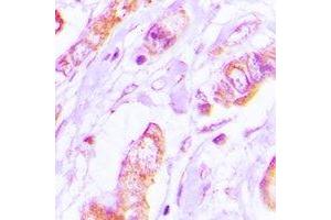 Immunohistochemical analysis of Tropomyosin 2 staining in human lung cancer formalin fixed paraffin embedded tissue section. (TPM2 antibody)