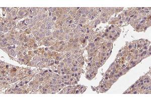 ABIN6276687 at 1/100 staining Human liver cancer tissue by IHC-P. (FSHR antibody  (Internal Region))