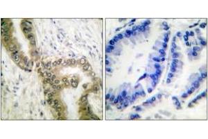 Immunohistochemistry analysis of paraffin-embedded human lung carcinoma tissue, using p53 (Acetyl-Lys386) Antibody. (p53 antibody  (acLys386))