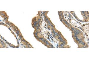 Immunohistochemistry of paraffin-embedded Human thyroid cancer tissue using TMPRSS13 Polyclonal Antibody at dilution 1:40 (TMPRSS13 antibody)