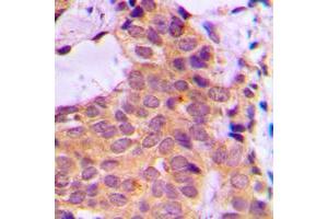 Immunohistochemical analysis of PKC zeta staining in human breast cancer formalin fixed paraffin embedded tissue section. (PKC zeta antibody  (C-Term))
