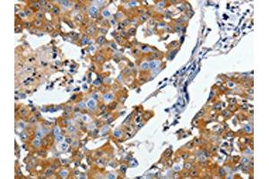 The image on the left is immunohistochemistry of paraffin-embedded Human breast cancer tissue using ABIN7190498(DPYSL5 Antibody) at dilution 1/10, on the right is treated with synthetic peptide. (DPYSL5 antibody)