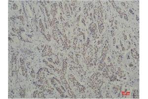 Immunohistochemistry (IHC) analysis of paraffin-embedded Human Breast Carcinoma using TBP/TATA Binding Protein Mouse Monoclonal Antibody diluted at 1:200.