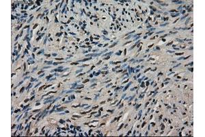 Immunohistochemical staining of paraffin-embedded Adenocarcinoma of colon tissue using anti-LDHAmouse monoclonal antibody. (Lactate Dehydrogenase A antibody)