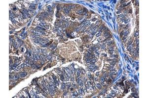 IHC-P Image CaMKK beta antibody detects CaMKK beta protein at cytoplasm in human endometrial cancer by immunohistochemical analysis. (CAMKK2 antibody  (N-Term))