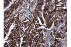 IHC-P Image CD89 antibody detects CD89 protein at cytoplasm in human cervical carcinoma by immunohistochemical analysis. (FCAR antibody)