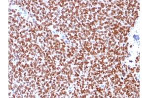 Formalin-fixed, paraffin-embedded human Ewing's Sarcoma stained with NKX2. (Recombinant Nkx2-2 antibody)