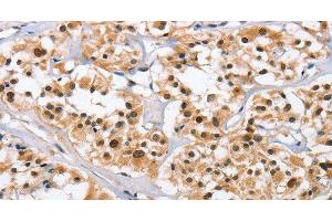 Immunohistochemistry of paraffin-embedded Human thyroid cancer tissue using NCAPD3 Polyclonal Antibody at dilution 1:50 (NCAPD3 antibody)