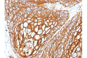 Formalin-fixed, paraffin-embedded human Basal Cell Carcinoma stained with CD9 Mouse Monoclonal Antibody (CD9/2343). (CD9 antibody)