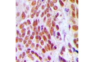 Immunohistochemical analysis of HMGB2 staining in human breast cancer formalin fixed paraffin embedded tissue section. (HMGB2 antibody)