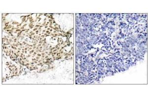 Immunohistochemical analysis of paraffin-embedded human breast carcinoma tissue using p95/NBS1 (Ab-343) antibody (E021058). (Nibrin antibody)