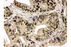Anti- SMC3 Picoband antibody, IHC(P) IHC(P): Human Intestinal Cancer Tissue (SMC3 antibody  (C-Term))