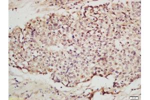 Formalin-fixed and paraffin embedded human layngocarcinoma labeled with Anti-IRF2 Polyclonal Antibody, Unconjugated  at 1:200 followed by conjugation to the secondary antibody and DAB staining. (IRF2 antibody  (AA 81-180))
