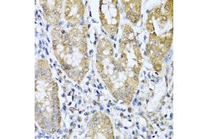 Immunohistochemistry of paraffin-embedded human gastric cancer using ASIP antibody (ABIN5974140) at dilution of 1/100 (40x lens). (ASIP antibody)