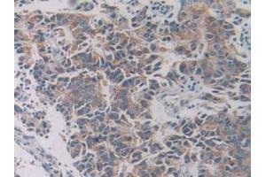 IHC-P analysis of Human Prostate Gland Cancer Tissue, with DAB staining. (SLC12A3 antibody  (AA 867-1024))