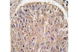 IHC analysis of FFPE human lung carcinoma tissue stained with IKK beta antibody (IKBKB antibody)