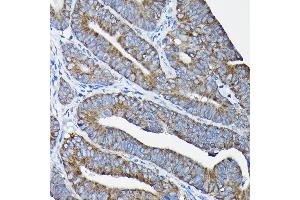 Immunohistochemistry of paraffin-embedded human colon carcinoma using Nesprin 1 Rabbit pAb (ABIN7270520) at dilution of 1:100 (40x lens).