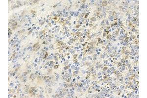 ABIN6259327 and ABIN6275300 at 1/100 staining human melanoma by IHC-P. (NBPF5 antibody)
