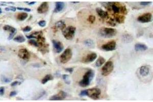 Immunohistochemistry (IHC) analyzes of FoxO4 antibody in paraffin-embedded human breast carcinoma tissue. (FOXO4 antibody)