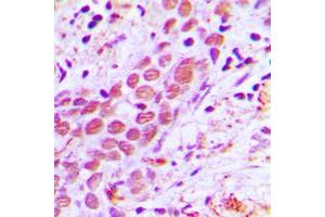 Immunohistochemical analysis of USF2 staining in human breast cancer formalin fixed paraffin embedded tissue section. (USF2 antibody  (Center))