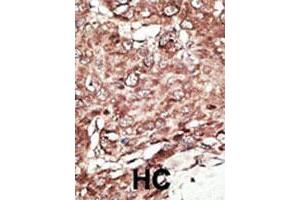 Formalin-fixed and paraffin-embedded human hepatocellular carcinoma tissue reacted with the primary antibody, which was peroxidase-conjugated to the secondary antibody, followed by AEC staining. (PRMT7 antibody  (N-Term))
