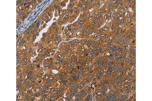 Immunohistochemistry of Human thyroid cancer using ADAMTS15 Polyclonal Antibody at dilution of 1:40