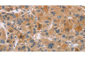 Immunohistochemistry of paraffin-embedded Human liver cancer using CYP4A11 Polyclonal Antibody at dilution of 1:30 (CYP4A11 antibody)