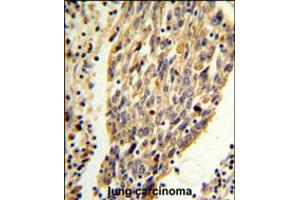 PKM2 (N-term E131) Antibody IHC analysis in formalin fixed and paraffin embedded human lung carcinoma followed by peroxidase conjugation of the secondary antibody and DAB staining. (PKM2 antibody  (N-Term))