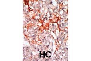 Formalin-fixed and paraffin-embedded human hepatocellular carcinoma tissue reacted with MATK polyclonal antibody  , which was peroxidase-conjugated to the secondary antibody, followed by DAB staining.