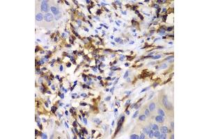 Immunohistochemistry of paraffin-embedded human liver cancer using HCLS1 antibody (ABIN3023093, ABIN3023094, ABIN3023095 and ABIN6219386) at dilution of 1:100 (40x lens). (HCLS1 antibody  (AA 1-280))