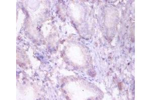 Immunohistochemistry of paraffin-embedded human prostate tissue using ABIN7173377 at dilution of 1:50 (HADHB antibody  (AA 35-283))