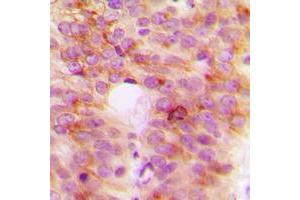Immunohistochemical analysis of TANK staining in human breast cancer formalin fixed paraffin embedded tissue section. (TANK antibody  (Center))