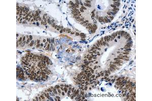 Immunohistochemistry of Human ovarian cancer using LRP5 Polyclonal Antibody at dilution of 1:55