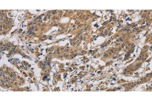 Immunohistochemistry of paraffin-embedded Human gastric cancer using CYCS Polyclonal Antibody at dilution of 1:50 (Cytochrome C antibody)