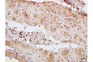 Formalin-fixed and paraffin embedded human gastric carcinoma labeled with Rabbit Anti Phospho-MEF2A (Thr312) Polyclonal Antibody, Unconjugated (ABIN743768) at 1:200 followed by conjugation to the secondary antibody and DAB staining