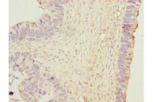 Immunohistochemistry of paraffin-embedded human ovarian cancer using ABIN7150502 at dilution of 1:100 (DNAJB1 antibody  (AA 1-340))