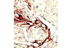 Formalin-fixed and paraffin-embedded human cancer tissue (breast carcinoma) reacted with the primary antibody, which was peroxidase-conjugated to the secondary antibody, followed by DAB staining. (LKB1 antibody  (N-Term))