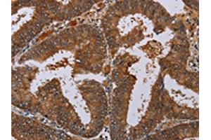The image on the left is immunohistochemistry of paraffin-embedded Human colon cancer tissue using ABIN7130067(LCMT1 Antibody) at dilution 1/20, on the right is treated with fusion protein. (LCMT1 antibody)