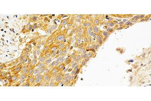 Immunohistochemistry of paraffin-embedded Human esophageal cancer using PRKCE Polyclonal Antibody at dilution of 1:200 (40x lens). (PKC epsilon antibody)