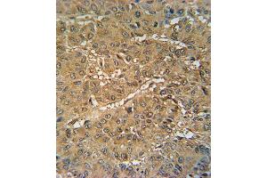 VKORC1 Antibody (N-term) (ABIN652040 and ABIN2840514) immunohistochemistry analysis in formalin fixed and paraffin embedded human hepatocarcinoma followed by peroxidase conjugation of the secondary antibody and DAB staining. (VKORC1 antibody  (N-Term))