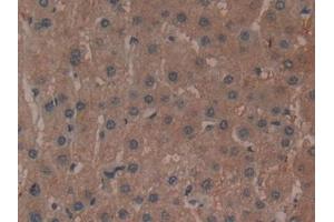 Detection of ADCY3 in Human Liver cancer Tissue using Polyclonal Antibody to Adenylate Cyclase 3 (ADCY3) (ADCY3 antibody  (AA 501-736))