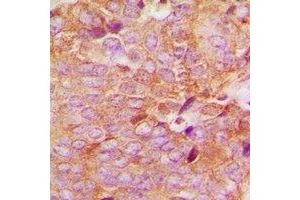 Immunohistochemical analysis of MKK6 staining in human breast cancer formalin fixed paraffin embedded tissue section. (MAP2K6 antibody  (N-Term))