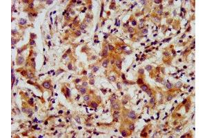 IHC image of ABIN7144009 diluted at 1:200 and staining in paraffin-embedded human liver cancer performed on a Leica BondTM system. (AMMECR1 antibody  (AA 146-248))