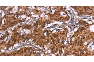 Immunohistochemistry of paraffin-embedded Human gastric cancer tissue using HIPK1 Polyclonal Antibody at dilution 1:30 (HIPK1 antibody)