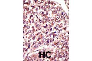 Formalin-fixed and paraffin-embedded human hepatocellular carcinoma tissue reacted with MGAT1 polyclonal antibody  , which was peroxidase-conjugated to the secondary antibody, followed by AEC staining . (MGAT1 antibody  (C-Term))