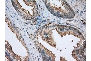 Immunohistochemical staining of paraffin-embedded Adenocarcinoma of ovary tissue using anti-ALDH3A1 mouse monoclonal antibody. (ALDH3A1 antibody)