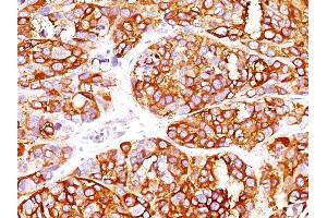 Formalin-fixed, paraffin-embedded human Melanoma stained with MART-1 Rabbit Recombinant Monoclonal Antibody (MLANA/1409R). (Recombinant MLANA antibody)