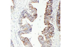 Anti-GST3/GST pi antibody, IHC(P) IHC(P): Human Intestinal Cancer Tissue (GSTP1 antibody  (N-Term))